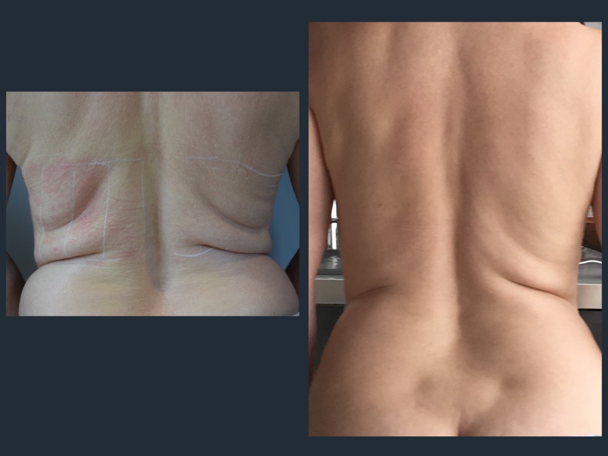 Dos et poignées d'amour - Avant / Après