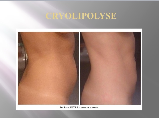 Ventre - Avant / Après