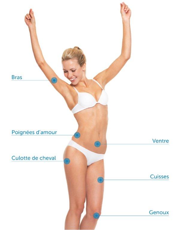 Zones de traitement cryolipolyse