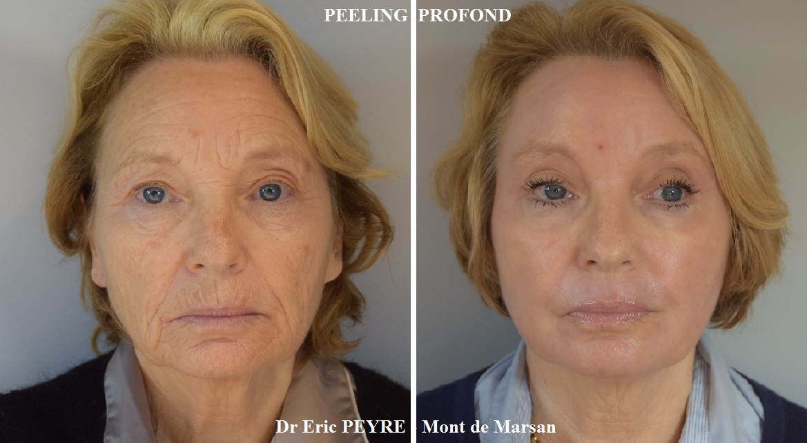Appareil de peeling-profond