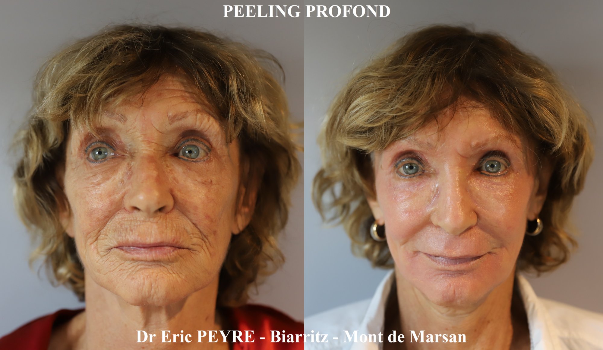 Peeling profond - Résultat spectaculaire