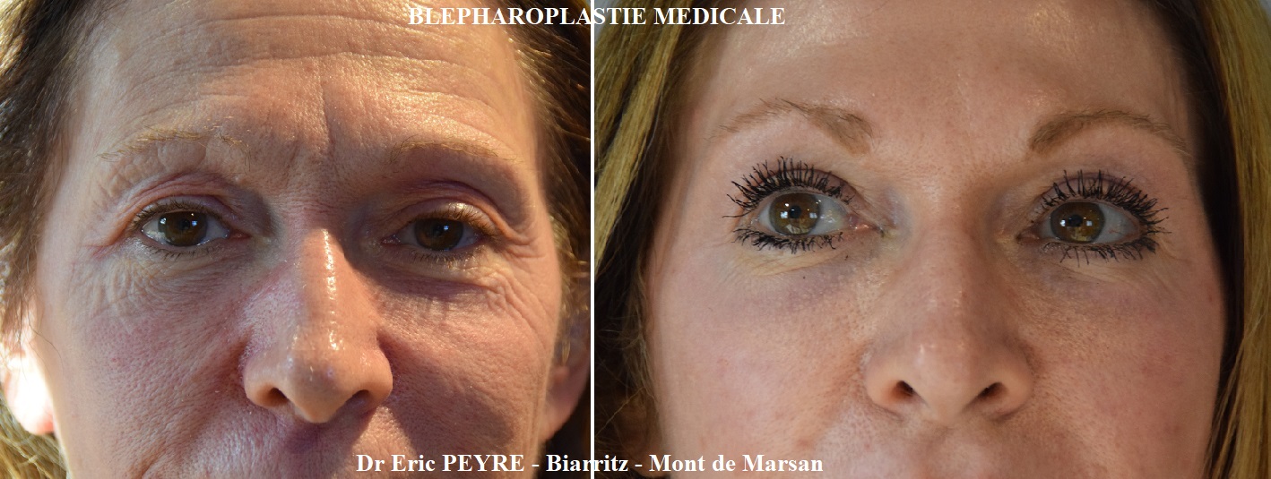 Appareil de peeling-profond